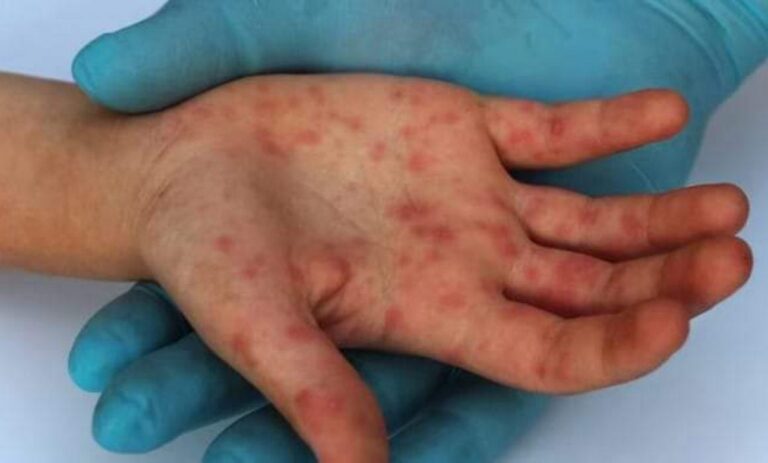 Al fin de la emergencia por la viruela del mono, Edomex suma 366 casos