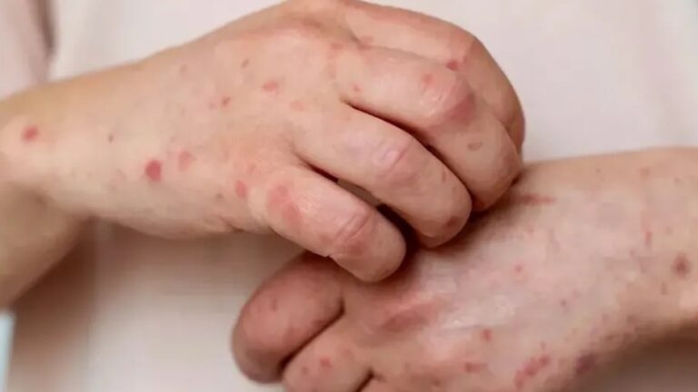 Edomex reporta sus tres primeros casos de sarampión