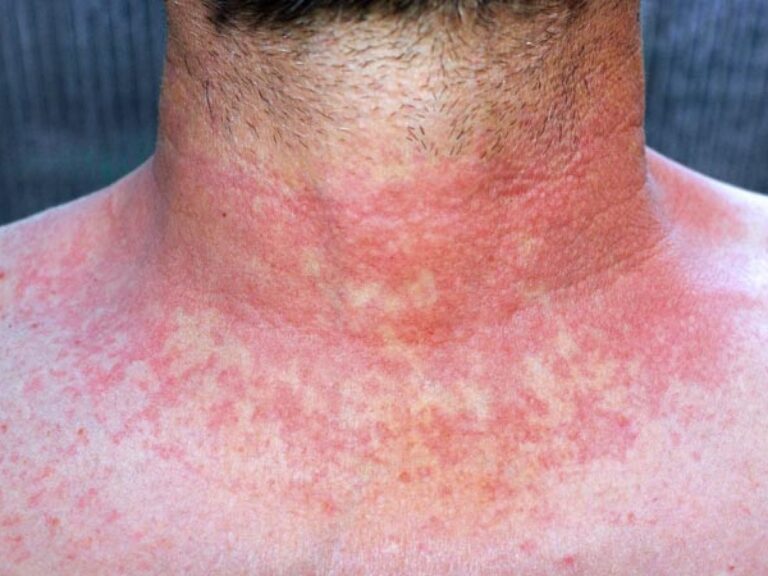 Aumentan casos de escarlatina en el Estado de México