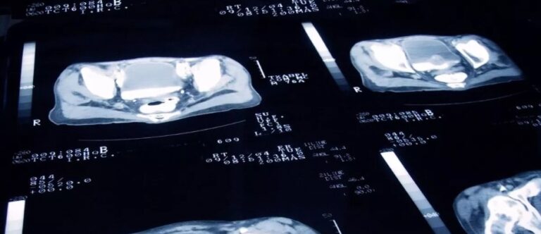 Cáncer de próstata: edad recomendada para el primer chequeo y síntomas de alerta