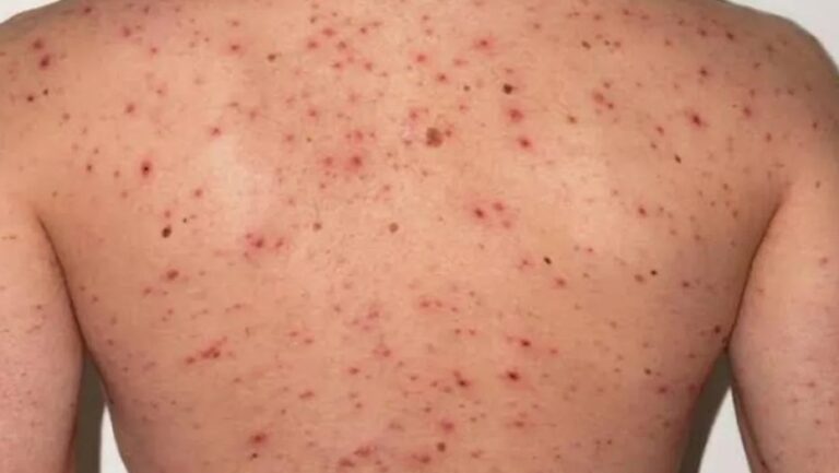 Enero registra 18 casos de sarampión en Edomex; superan a los registrados en 2025