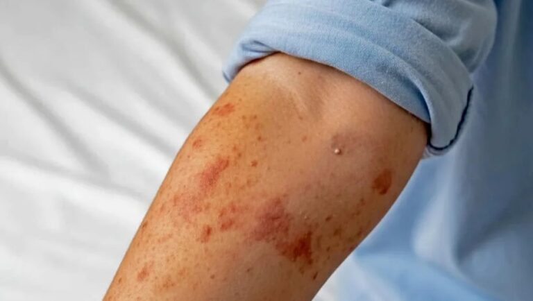 Registran en una semana 10 nuevos casos de sarampión en Edomex; suman 28 en lo que va del año