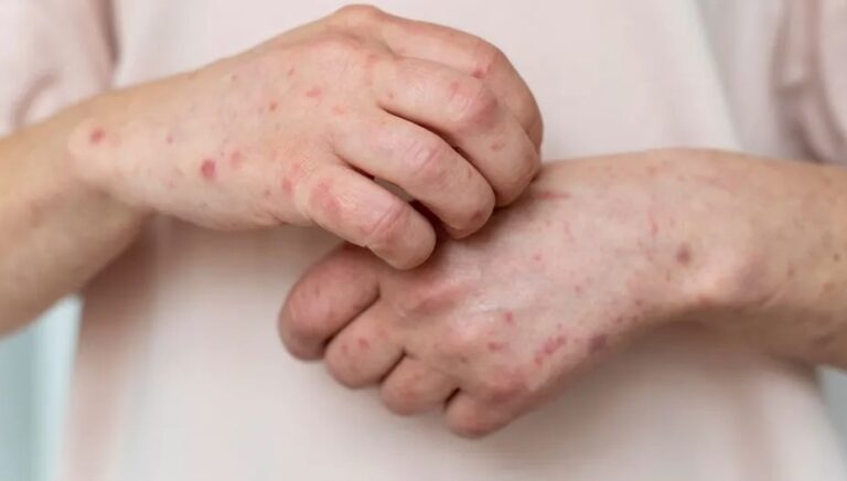 Reportan la primera muerte asociada al sarampión en la Ciudad de México