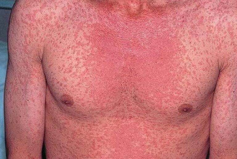 Comienza desaceleración de contagios de sarampión en el Edomex