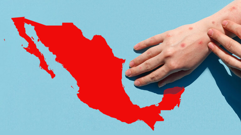 Secretaria de Salud Federal coloca al Edomex en el sexto lugar por casos de sarampión en México